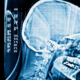 How Does a Whiplash Brain Injury Occur? Burge & Burge