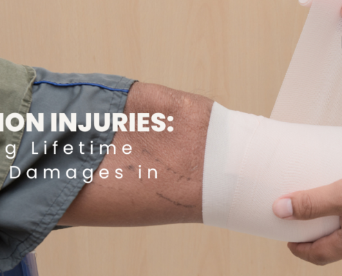 Amputation Injuries: Calculating Lifetime Costs and Damages in Alabama